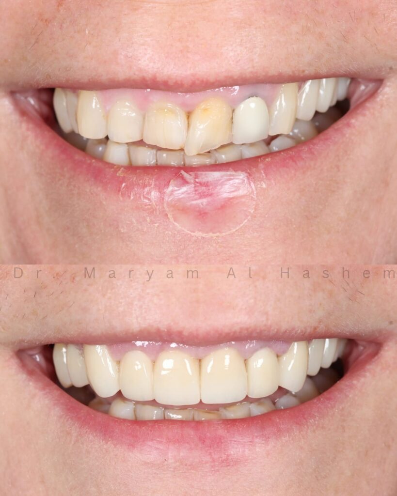 Smile Makeover Pdc1