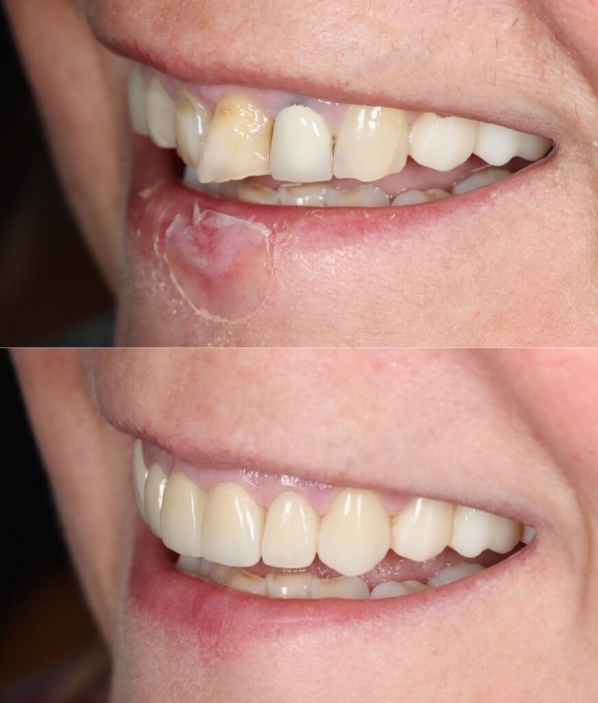 Smile Makeover Pdc2